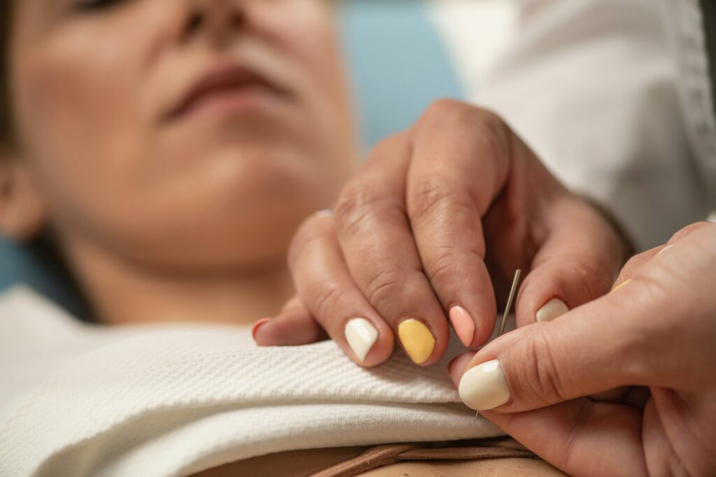 Acupuncture therapy for Stress Relief
